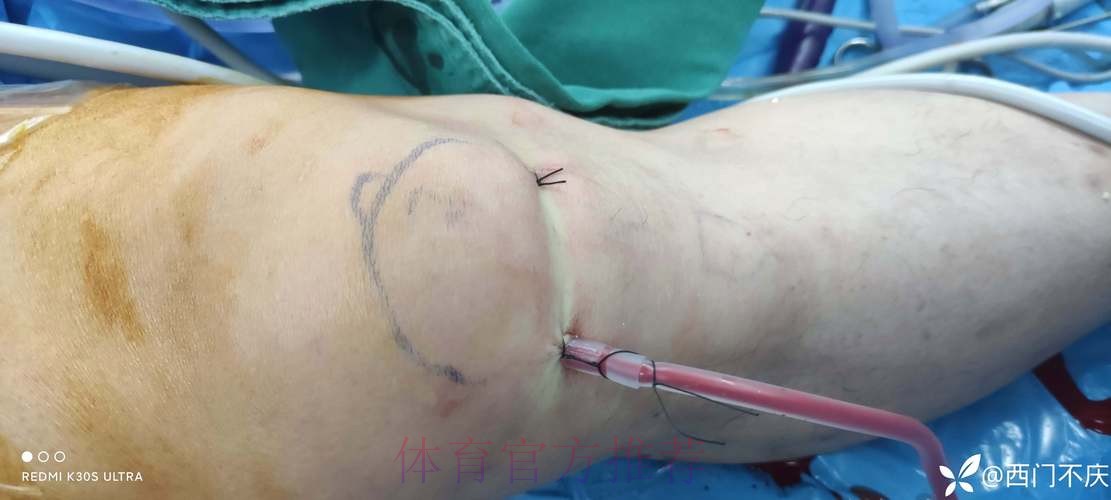 官方:阿拉巴成功接受了左膝内侧半月板撕裂手术 官方:阿拉巴成功接受了左膝内侧半月板撕裂手术